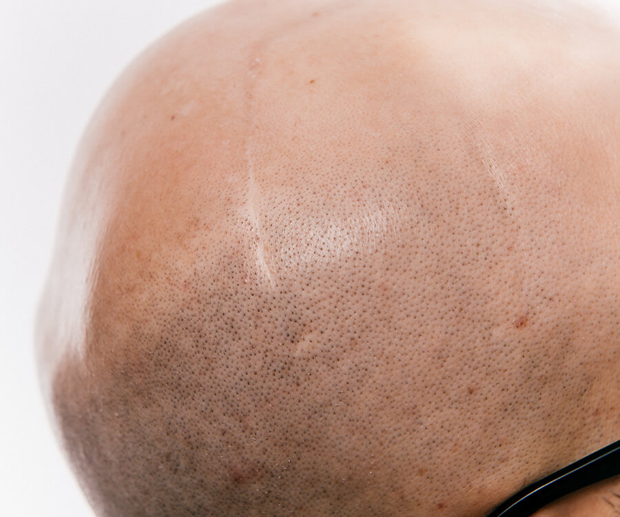 Scalp Micropigmentation Cambridge for Alopecia and Scars